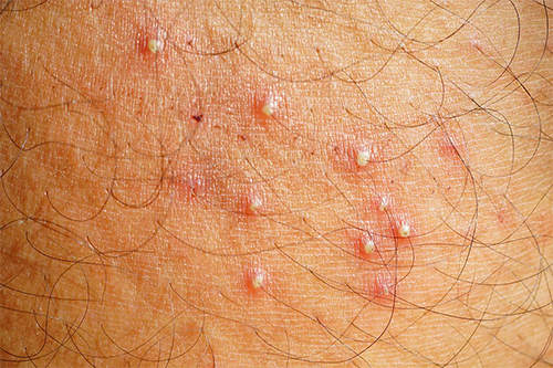 What Is Folliculitis?