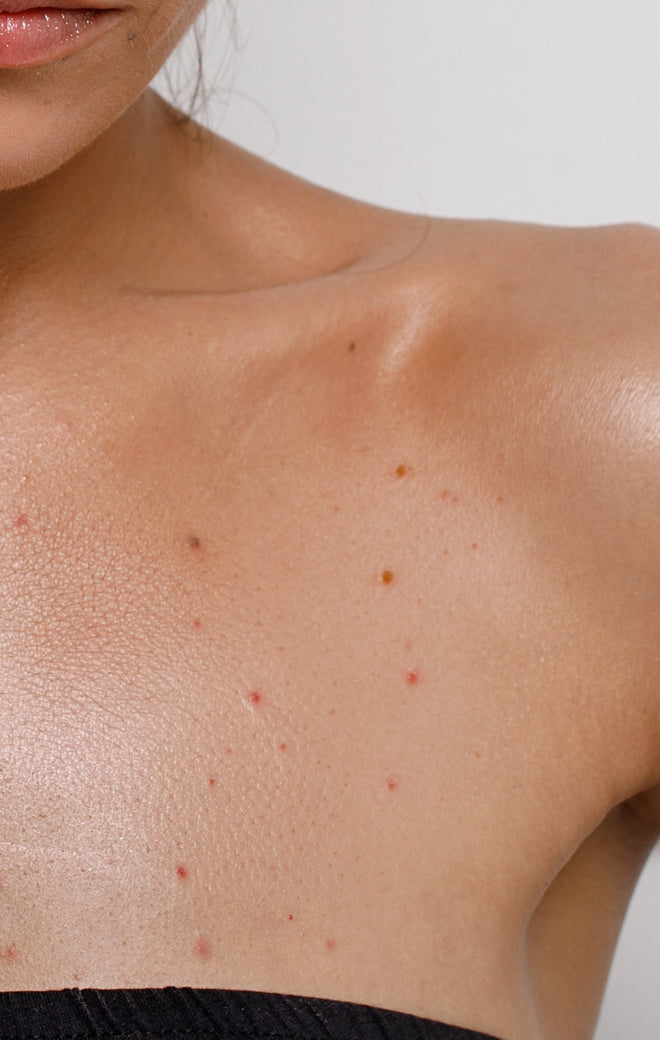 Body Acne Causes