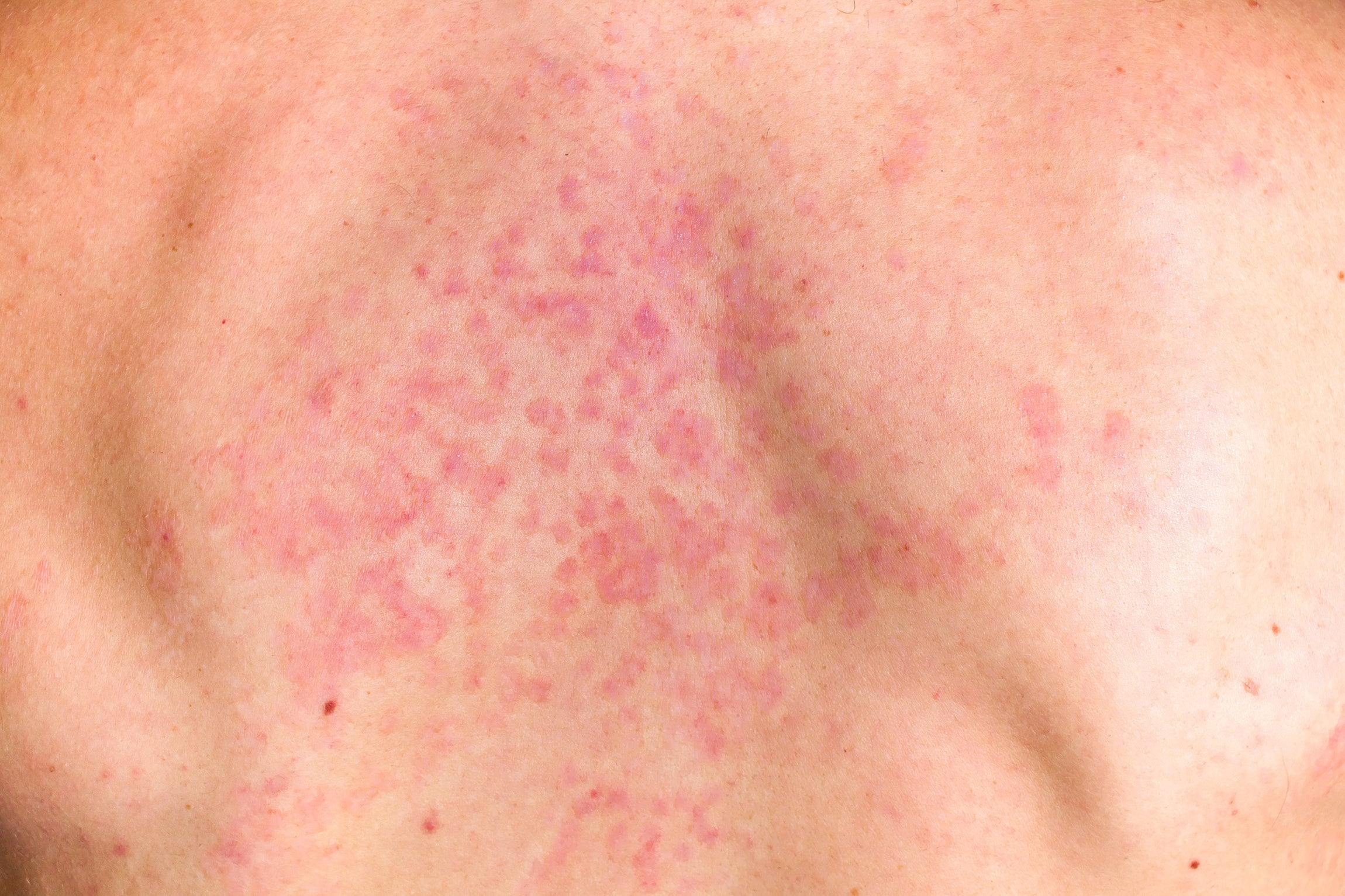 Fungal Acne vs. Folliculitis Acne