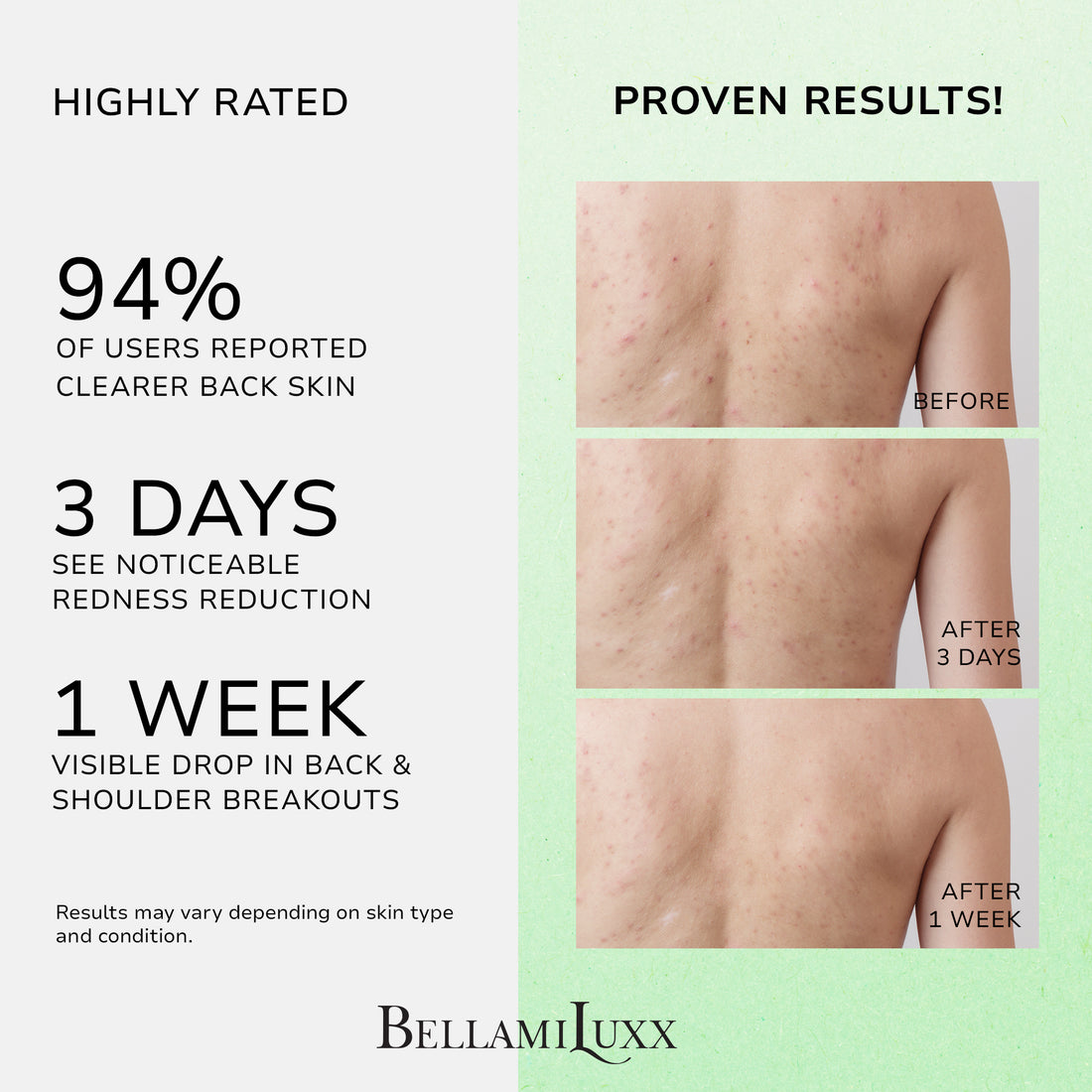 Back Acne Treatment Spray: Body Acne Treatment with 2% Salicylic Acid and Tea Tree Oil, Herbal Formula Acne Treatment For Teens, Back Acne Solution, 4.05 Ounce