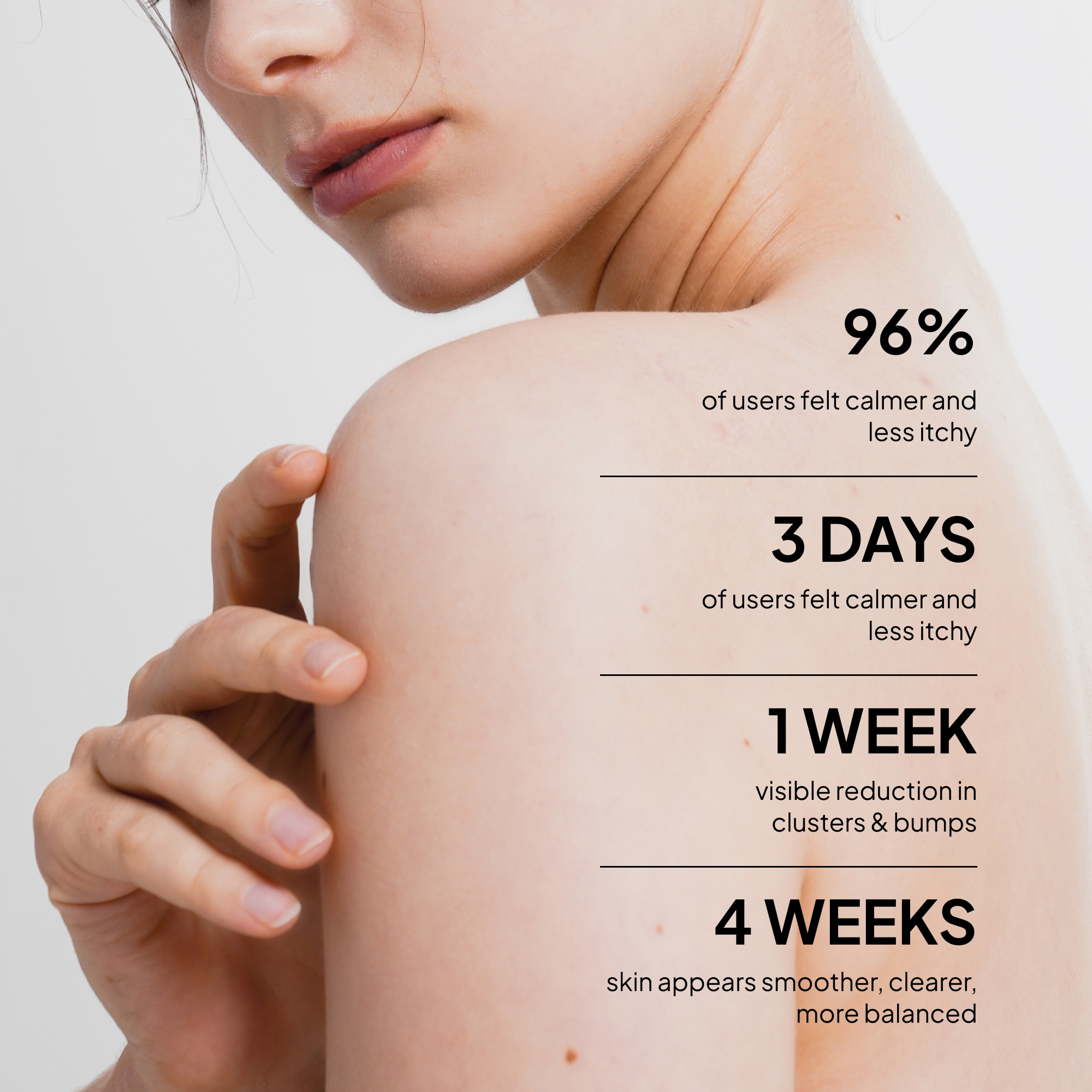 Fungal Acne Treatment Lotion: Effective Face & Body Pimple Cream for Bumps, Clusters, Itch & Redness – Fungal Prone Skin Acne Treatment Moisturizer for Teens & Adults with Natural Actives