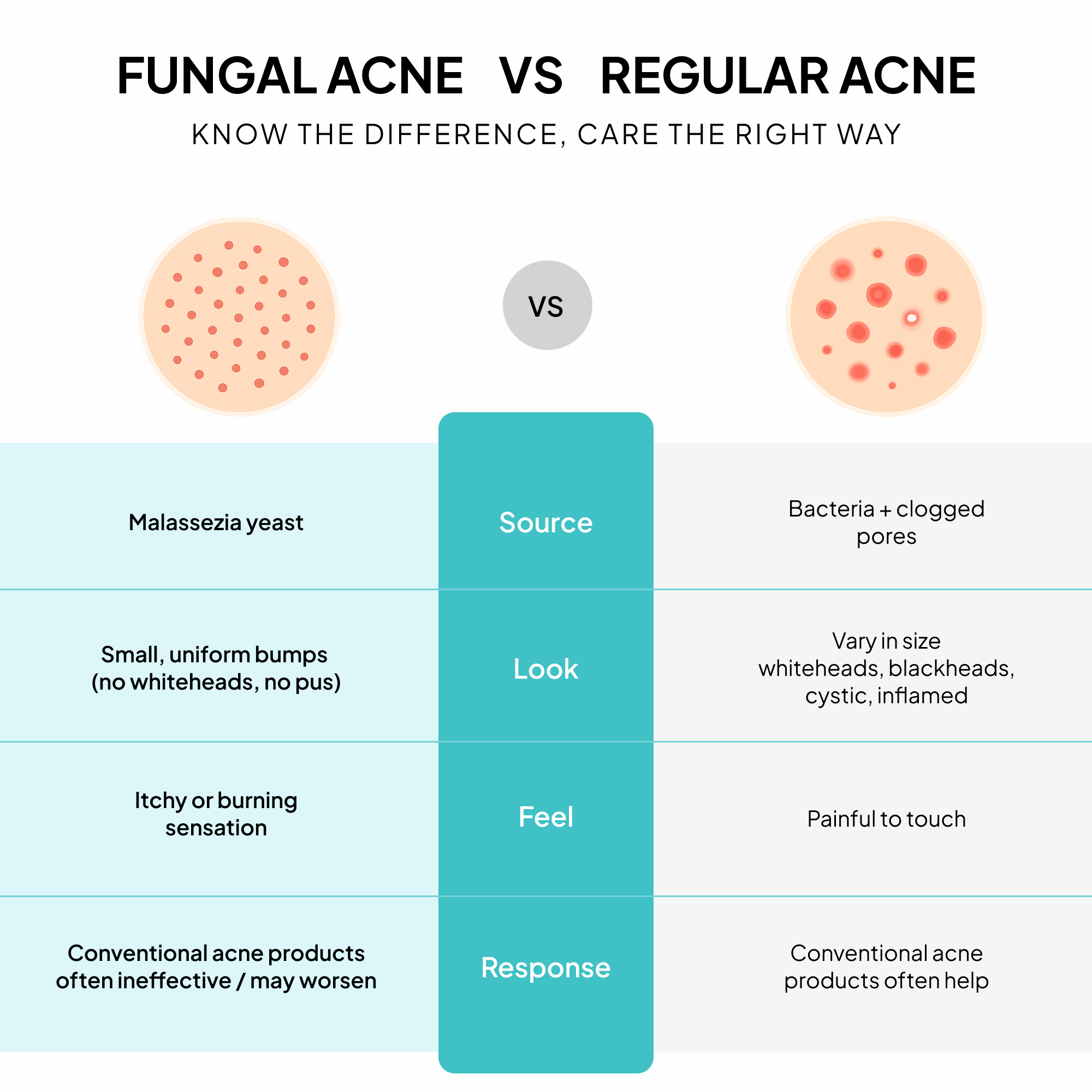 Fungal Acne Treatment Lotion: Effective Face & Body Pimple Cream for Bumps, Clusters, Itch & Redness – Fungal Prone Skin Acne Treatment Moisturizer for Teens & Adults with Natural Actives