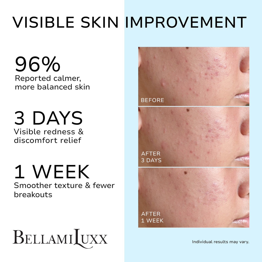 Cystic Acne Treatment for Face: Hormonal Acne Treatment Cream for Teens & Adults - Salicylic Acid & Tea Tree Oil Pimple Spot Remover - Anti-Acne Moisturizer Reduces Redness, Blemishes