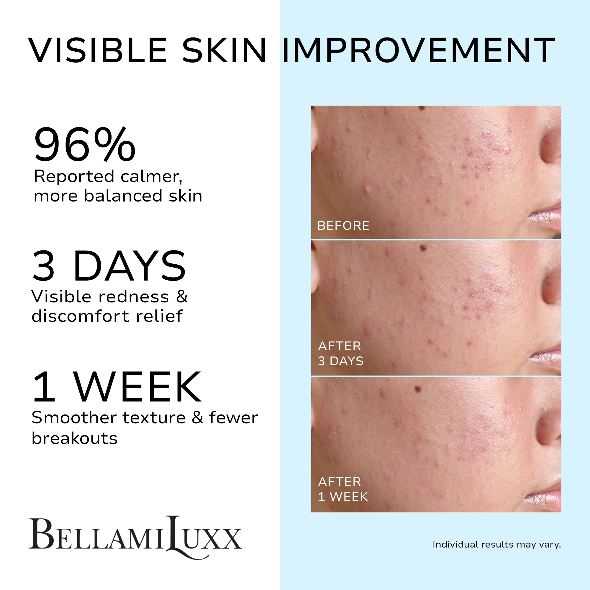 Cystic Acne Treatment for Face: Hormonal Acne Treatment Cream for Teens & Adults - Salicylic Acid & Tea Tree Oil Pimple Spot Remover - Anti-Acne Moisturizer Reduces Redness, Blemishes