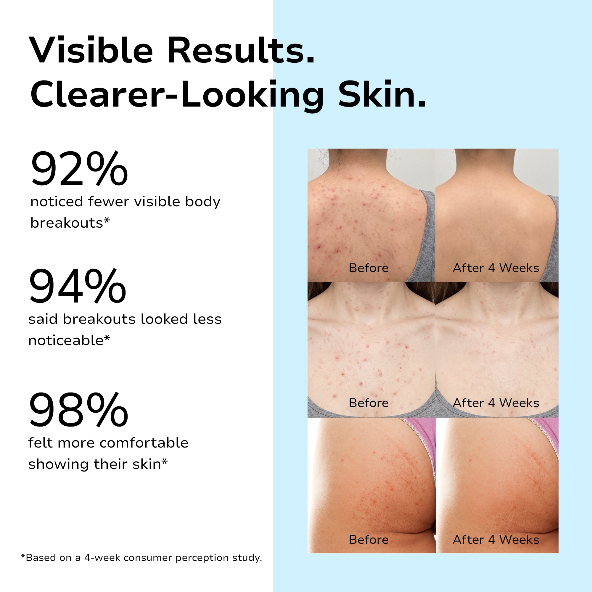 4% Benzoyl Peroxide Body Acne Wash