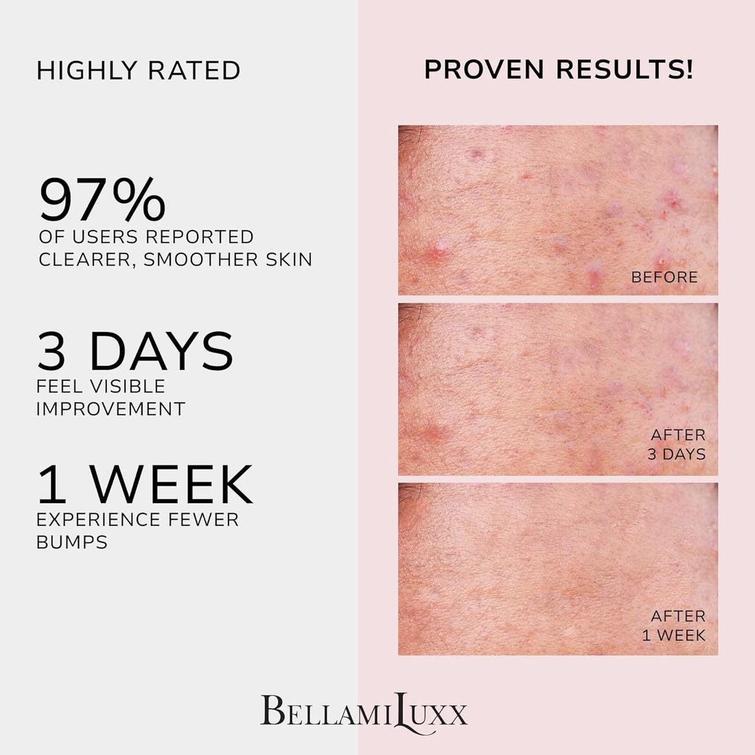 Body Acne Care Set: Butt Acne Treatment Lotion + Back & Body Acne Spray with 2% Salicylic Acid & Tea Tree Oil – Clears Breakouts, Soothes Redness & Prevents Bacne for Men, Women & Teens