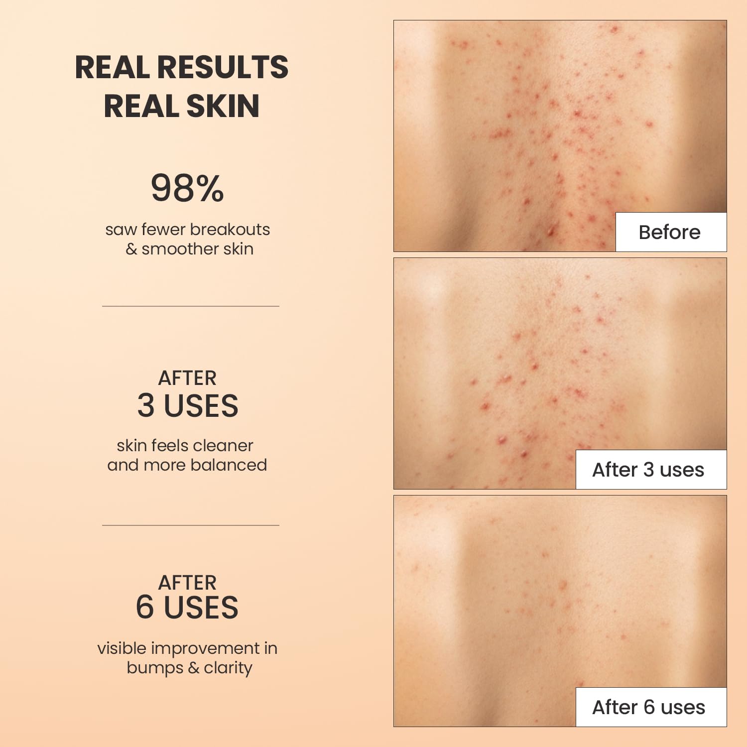 Body Acne Treatment Scrub: Helps Reduce Body Breakouts on Back, Chest, Butt & Thighs - Back Acne Treatment for Men, Women & Teens - Butt Acne Wash with Natural Actives for Smooth Skin