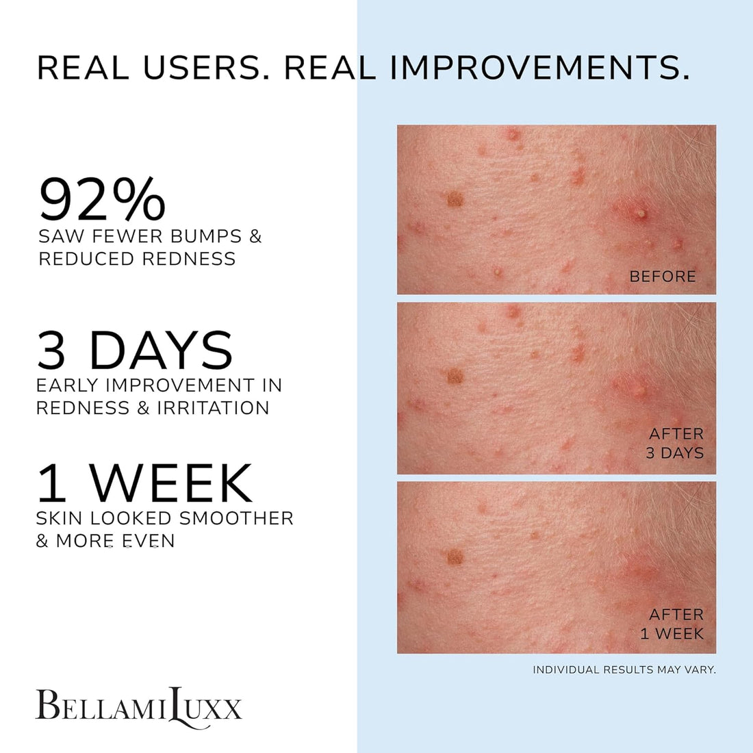 Folliculitis Acne Lotion for Body: Helps Reduce Itch, Redness, Body Acne, Bumps & Uneven Texture with Salicylic & Glycolic Acid + Botanicals - Gentle Care for Folliculitis-Prone Skin