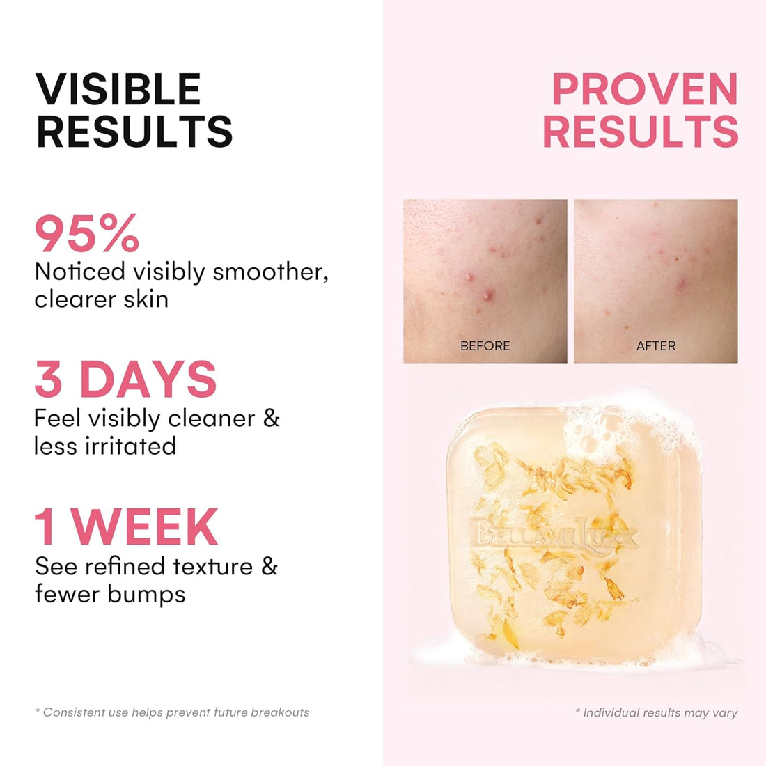 Body Acne Soap Bar: Antibacterial Bar for Butt, Thighs, Back, Body Acne, Folliculitis & Fungal Prone Skin - Tea Tree Oil, Sulfur & Salicylic Acid Soap - Reduce Bumps, Clogged Pores