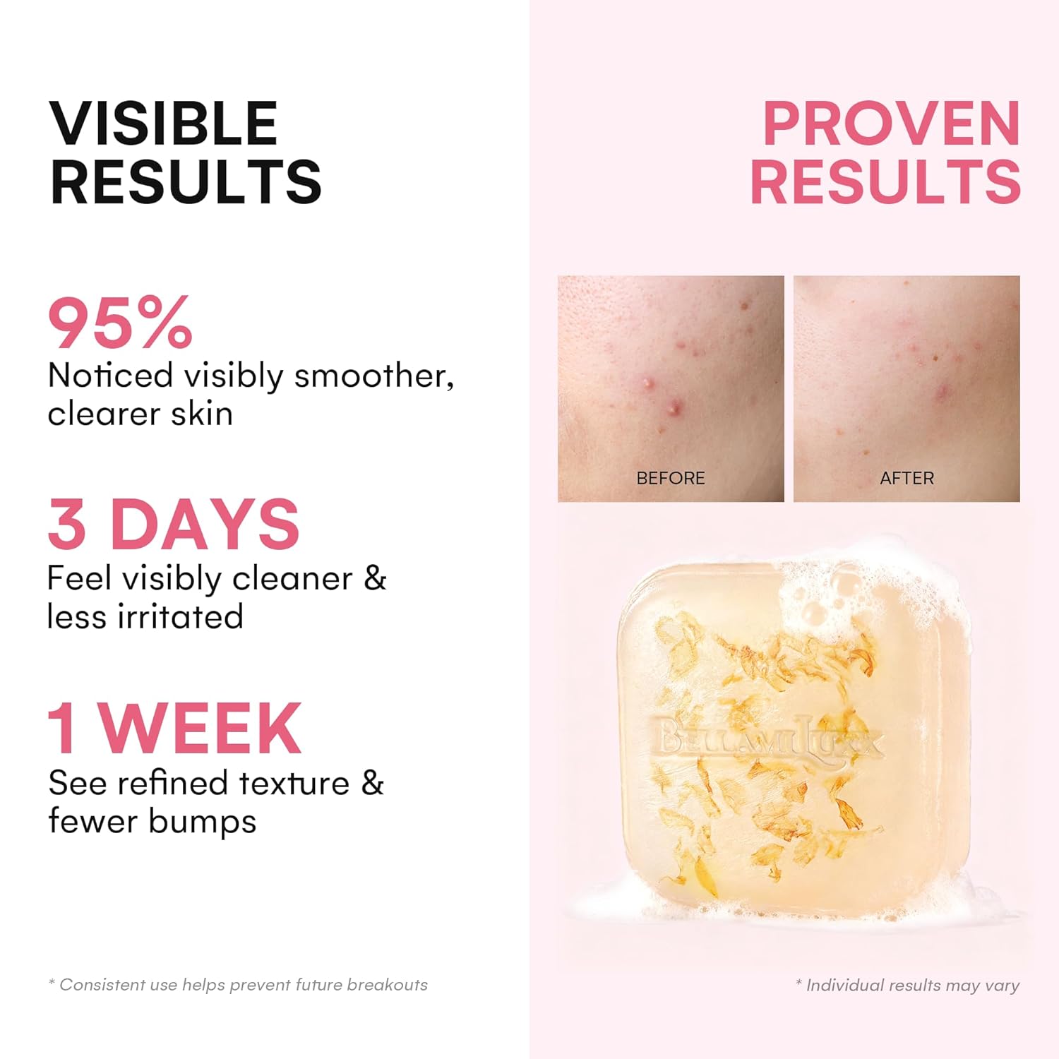 Body Acne Soap Bar: Antibacterial Bar for Butt, Thighs, Back, Body Acne, Folliculitis & Fungal Prone Skin - Tea Tree Oil, Sulfur & Salicylic Acid Soap - Reduce Bumps, Clogged Pores