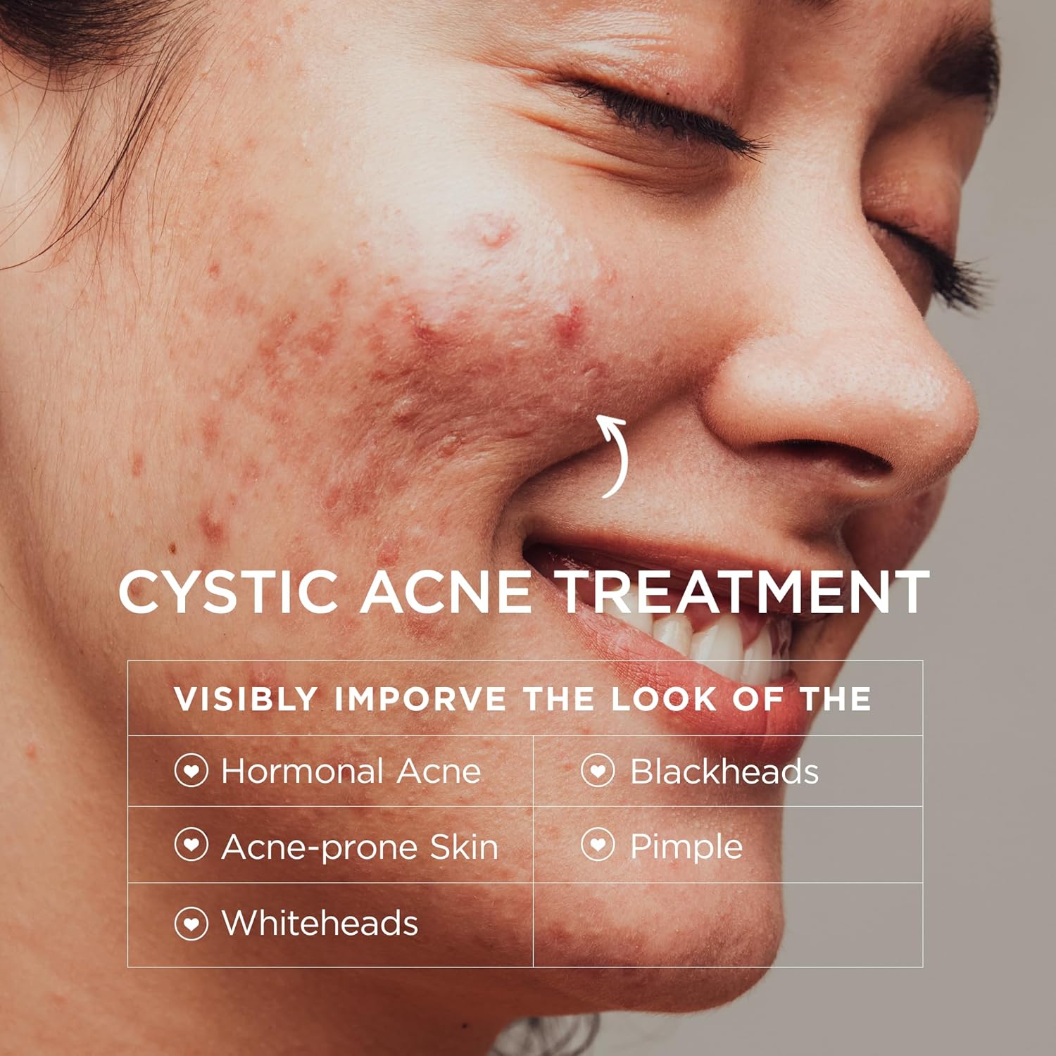 Cystic Acne Treatment for Face: Hormonal Acne Treatment Cream for Teens & Adults - Salicylic Acid & Tea Tree Oil Pimple Spot Remover - Anti-Acne Moisturizer Reduces Redness, Blemishes