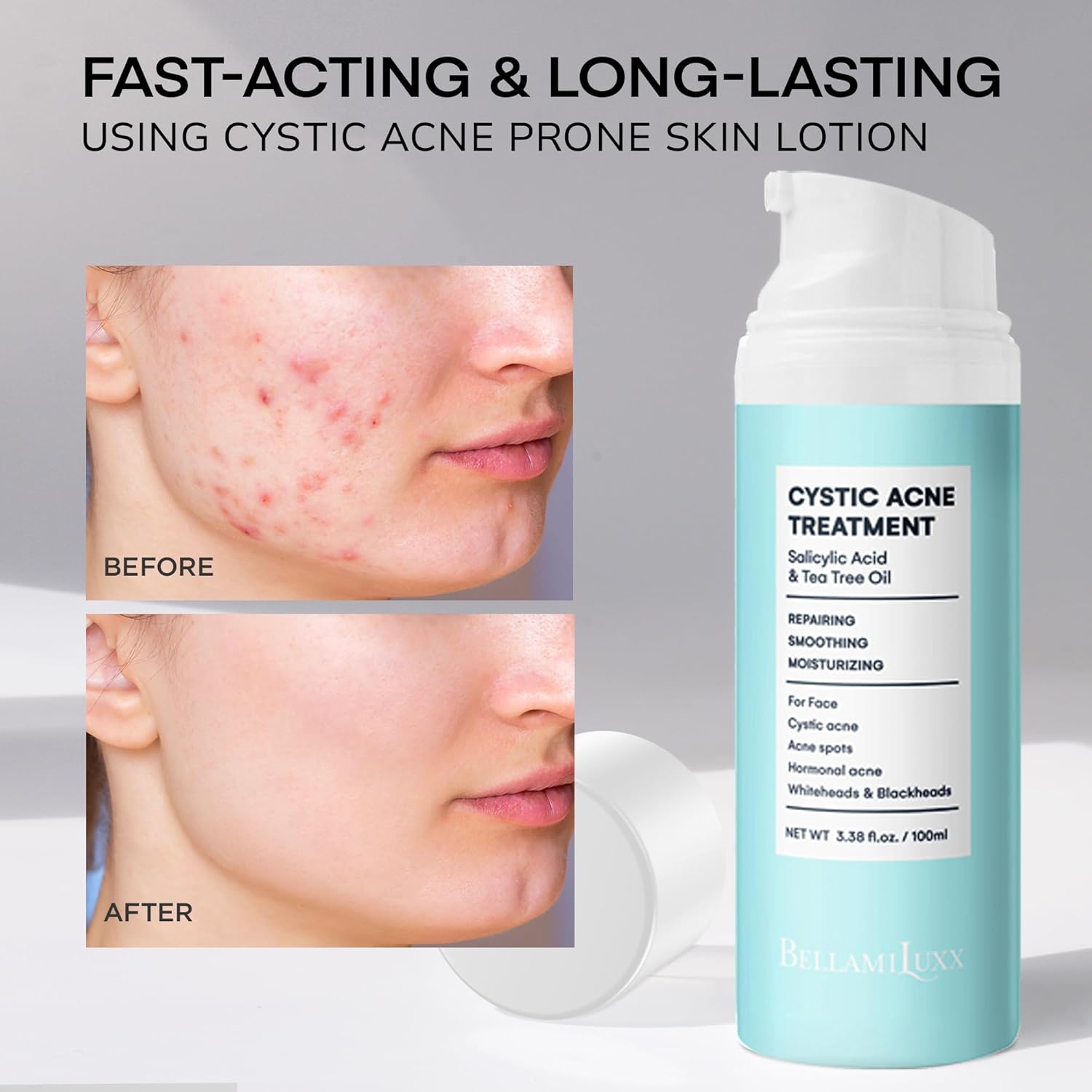 Cystic Acne Treatment for Face: Hormonal Acne Treatment Cream for Teens & Adults - Salicylic Acid & Tea Tree Oil Pimple Spot Remover - Anti-Acne Moisturizer Reduces Redness, Blemishes