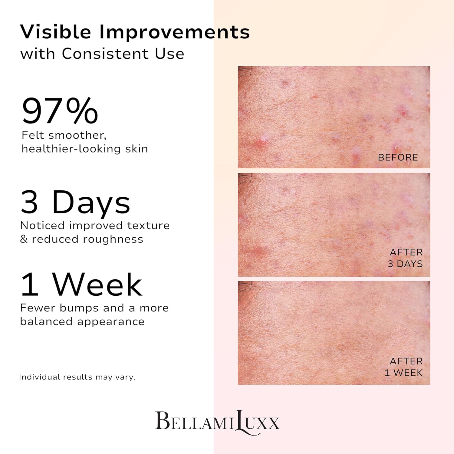 Butt Acne Clearing Set: Butt Acne Lotion + Acne Soap + Body Acne Scrub for Breakouts on Butt, Thighs, Back & Chest, KP Bumps, Clogged Pores & Rough Buttocks – Exfoliate, Cleanse & Smooth