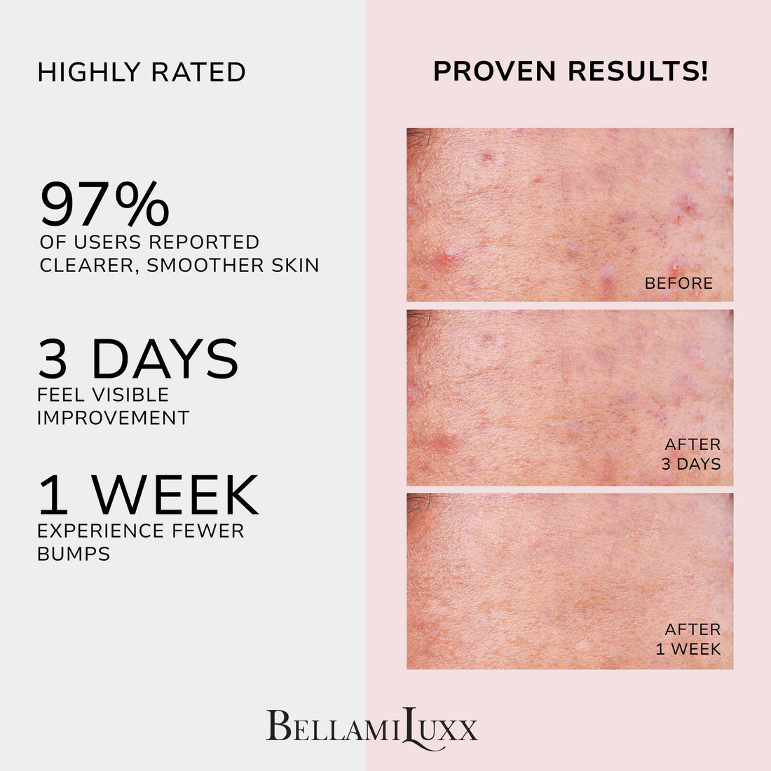 Butt Acne Clearing Treatment Cream: Body Acne Treatment for Folliculitis and Pimples on Buttocks, Thighs With 2% Salicylic Acid & Tea Tree Oil - Butt Cream for Smooth Skin