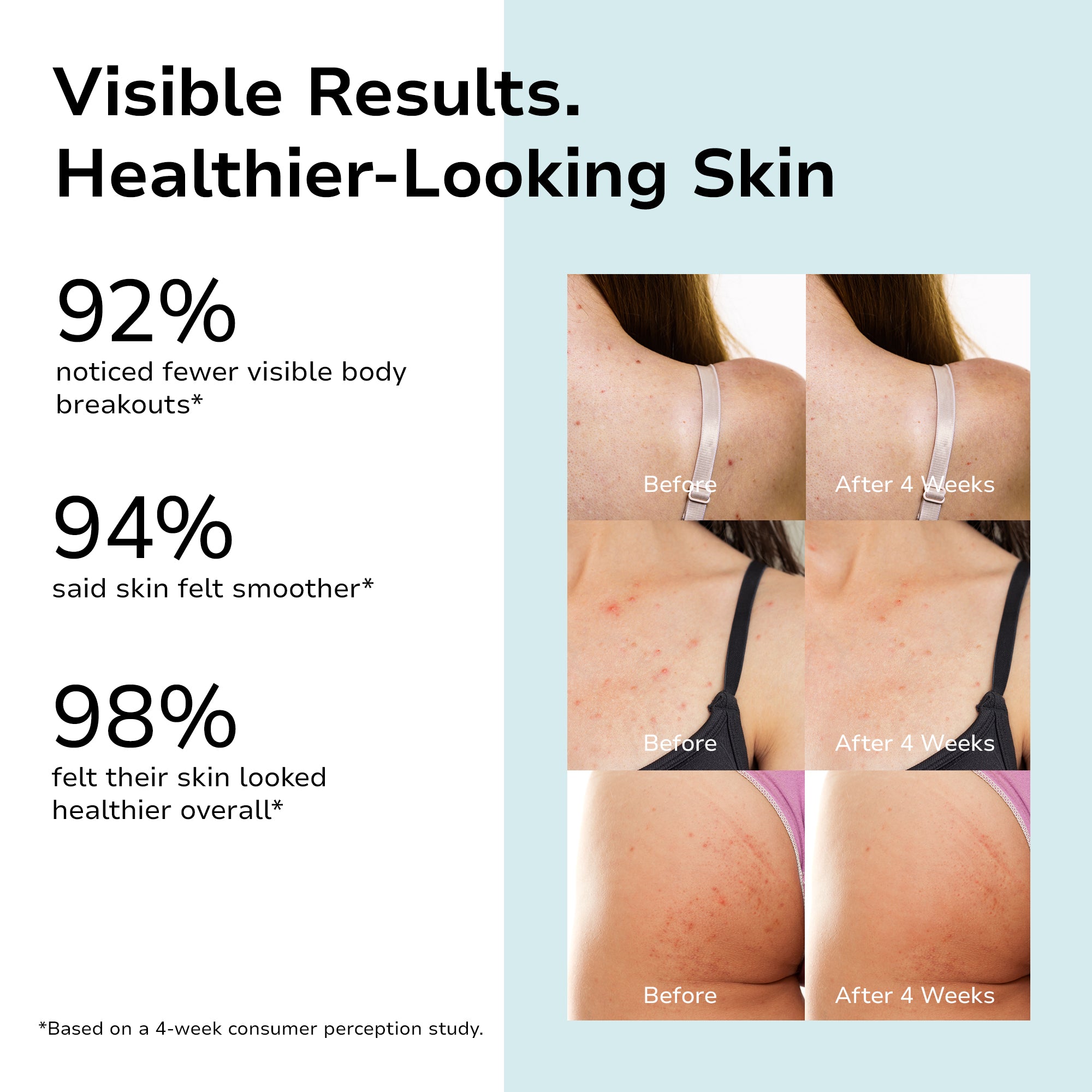 2% Salicylic Acid Body Acne Wash